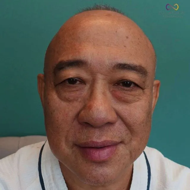Zoe Medical patient, front-facing clinical photo