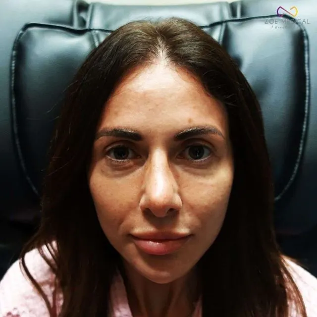 Zoe Medical patient, front-facing clinical photo