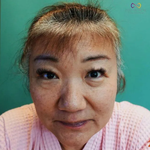 Zoe Medical patient, front-facing clinical photo
