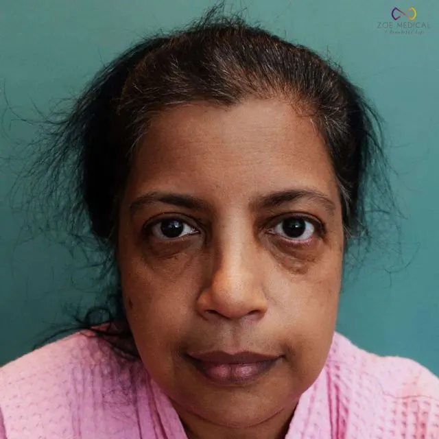 Zoe Medical patient, front-facing clinical photo