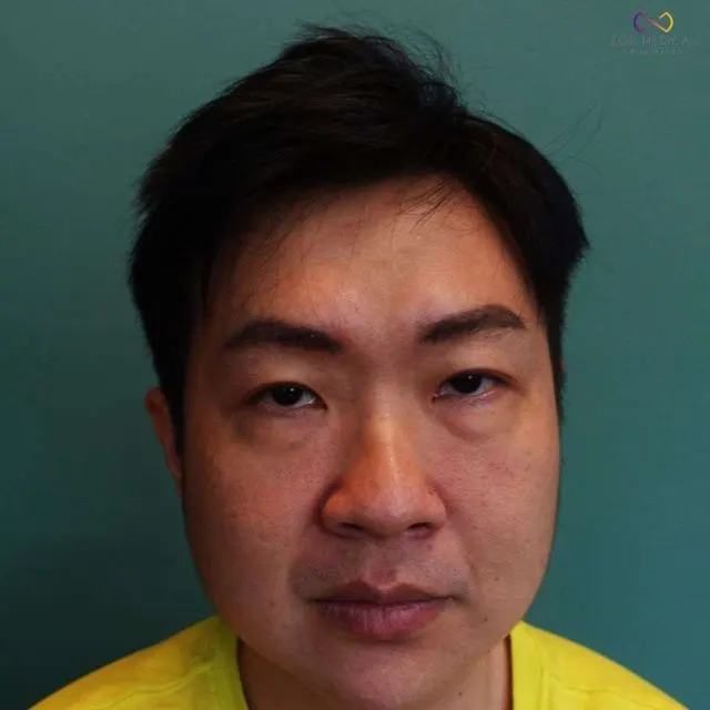 Zoe Medical patient, front-facing clinical photo