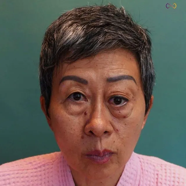 Zoe Medical patient, front-facing clinical photo