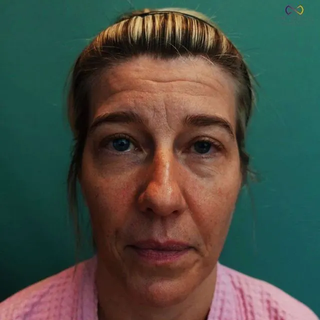 Zoe Medical patient, front-facing clinical photo