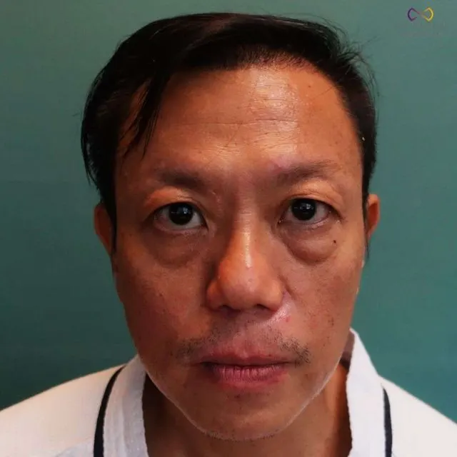 Zoe Medical patient, front-facing clinical photo