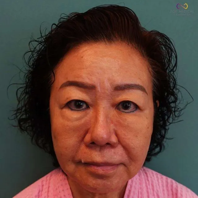 Zoe Medical patient, front-facing clinical photo
